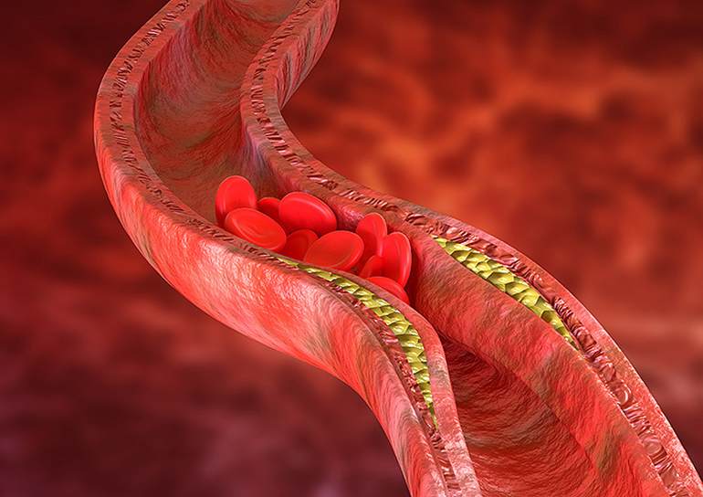 Cómo el exceso de colesterol afecta nuestra salud